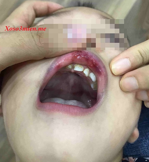 Bé trai gần 3 tuổi bị cô gái tát tụ máu môi
