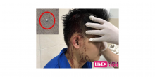 TPHCM: Đánh hội đồng và bắt đạn bị vào đầu đồng nghiệp vì mâu thuẫn
